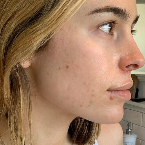 Hvordan behandler jeg voksen acne?